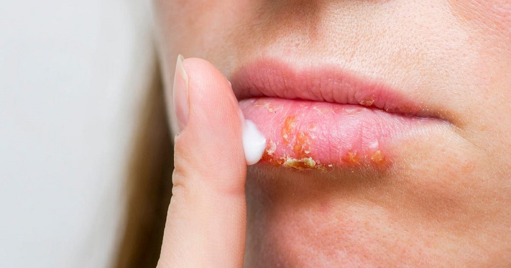How to prevent chapped / dry lips in winter