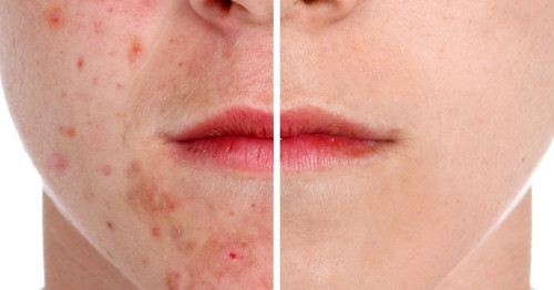 Here are behaviors and lifestyle habits that can make acne worse