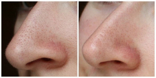 how to clear nose blackheads