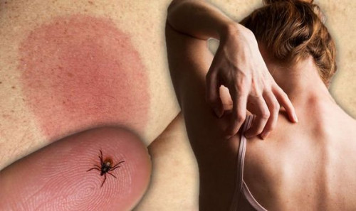 Things to avoid when you have acne